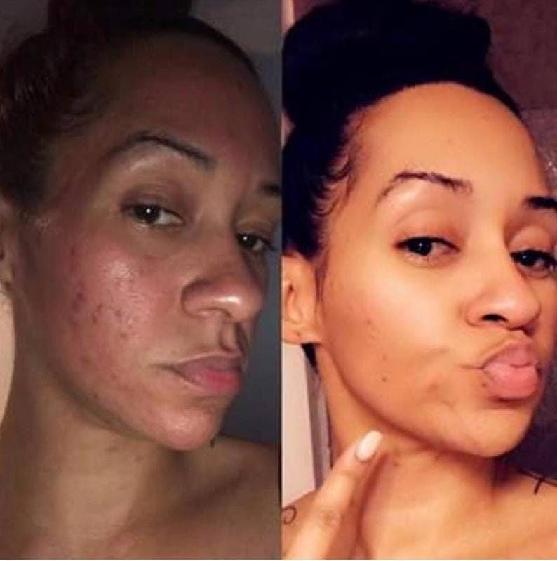 Turmeric Kojic Acid Soap - Imperfection / Hyperpigmentation