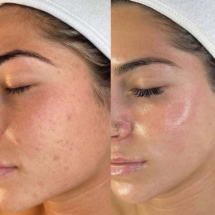 Derma Roller pour la croissance des cheveux et de la peau